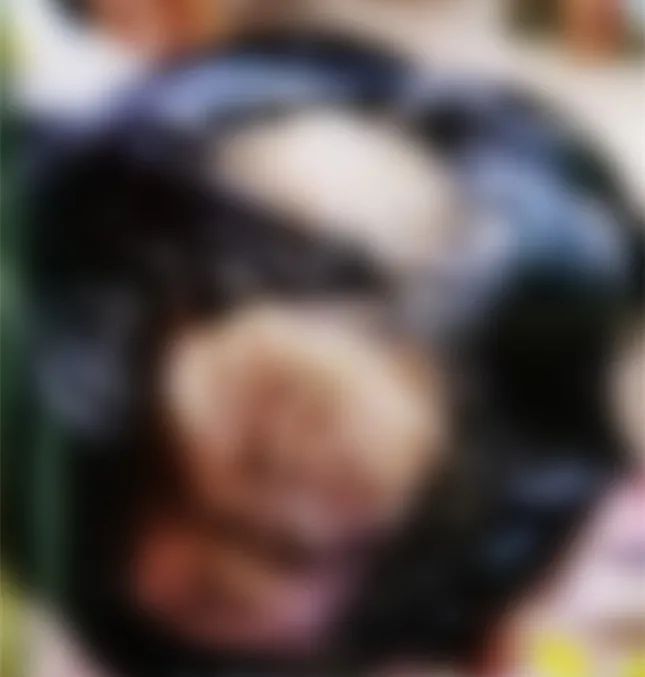 寄生虫|8岁女孩突然大量脱发头上还长脓包，一查竟与兔子有关