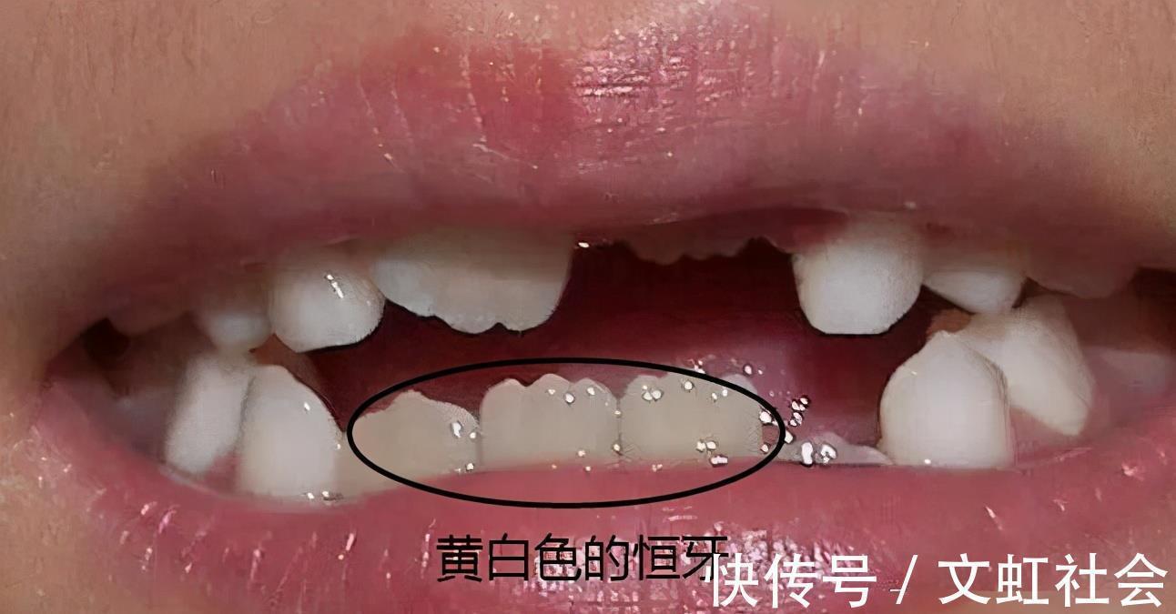 双排牙|最全儿童换牙时间表:儿童换牙何时开始、何时结束?一图说清