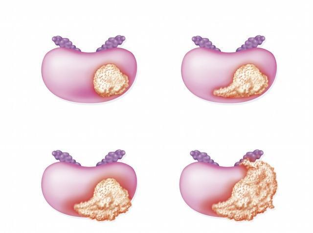 息肉|体检查出结节、息肉、增生、囊肿,哪个是癌症的先兆
