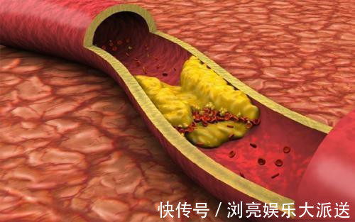 急性胰腺炎|甘油三脂3-5算是严重超标吗吃什么可以降下来医生说清楚