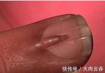 指甲|男子的指甲上长出“小手指”,去医院检查后,医生也是第一次看到