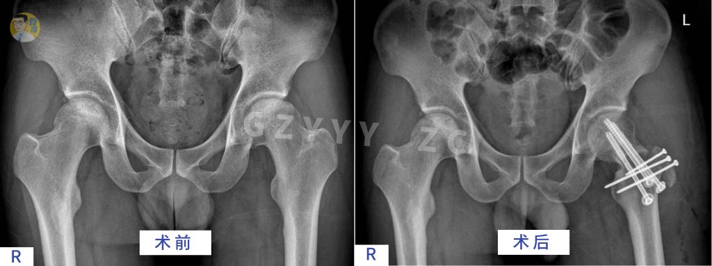 手术|看准、选对、做好——股骨头坏死保髋就这样成功了？