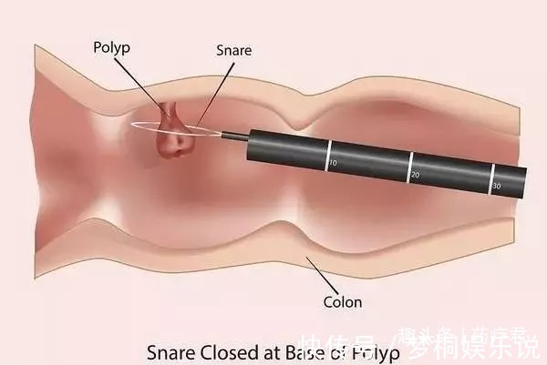 肠癌|肠子里长息肉后,身体会有什么感觉?为什么切了息肉还会得肠癌?