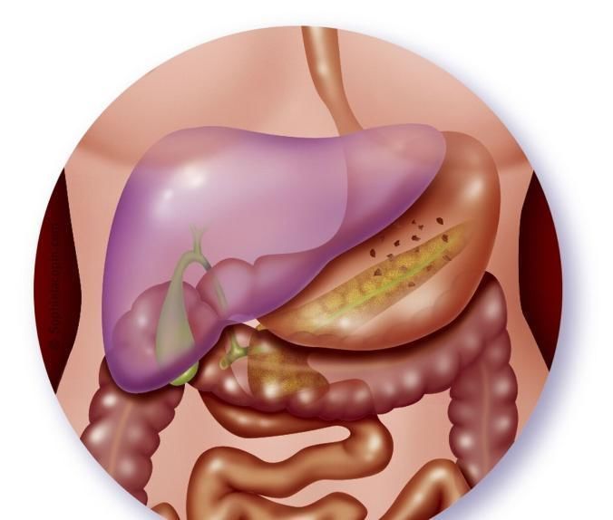 恶性|胰腺癌恶性程度第一的癌症一个神奇药方，竟能挽救晚期患者