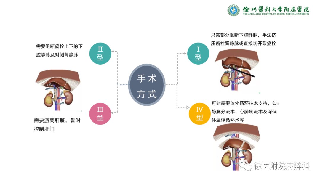 下腔静脉|肾癌伴下腔静脉癌栓患者的麻醉管理——早课学习