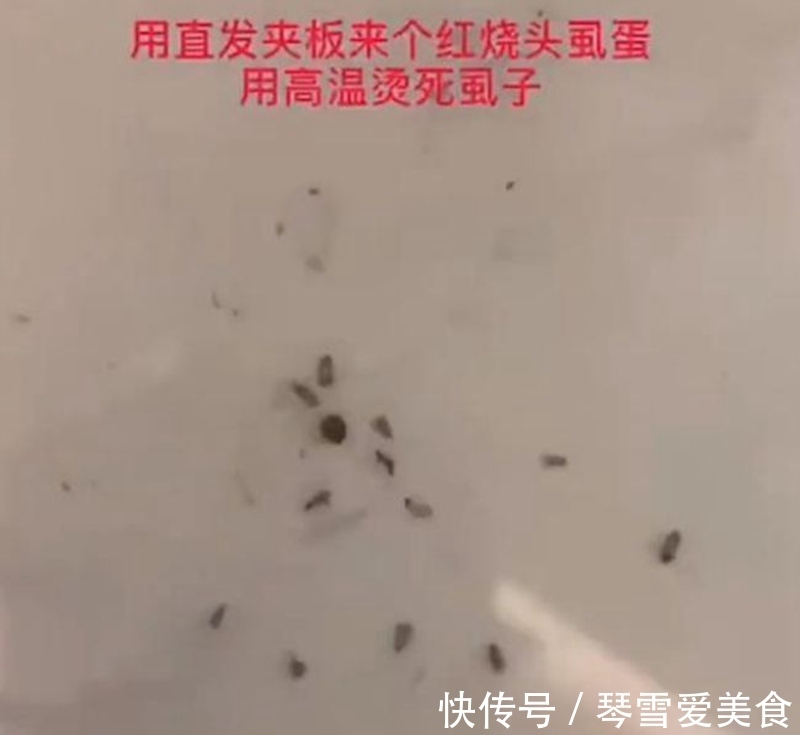 孩子|女儿住校被染上了头虱，妈妈用了这个方法后，虱子和虫卵被一锅端