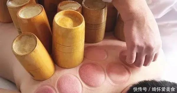 湿气|拔火罐到底吸出来是湿气，还是毒素？答案或和你想的不同