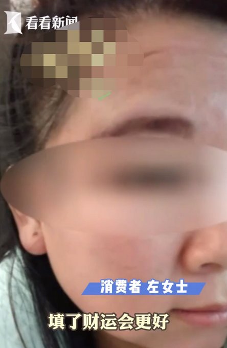 额头|女子为旺夫花4万填充额头出现凹坑，拖了两年都没解决！