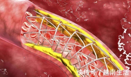 疏通血管|血管堵、血管硬，1个动作，每天拍一拍，疏通血管，冲走血管垃圾