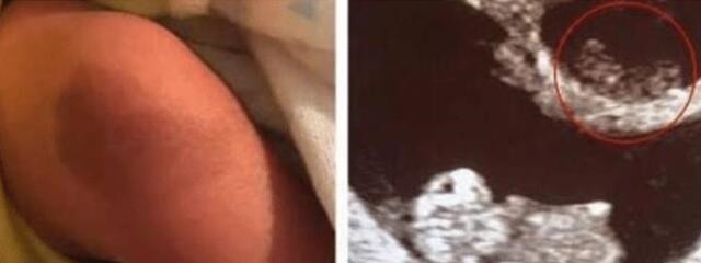 姐姐|“最美胎记”，姐姐在胎中被弟弟吸收，变成胎记留在弟弟腿上