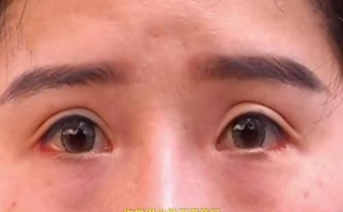 女子想做双眼皮，整形过后眼睑缺了一块，医院：不算整形失败