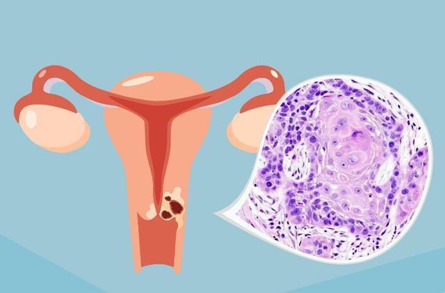 子宫内膜|52岁阿姨绝经后“倒开花”,查出宫颈癌,医生2现象别忽视