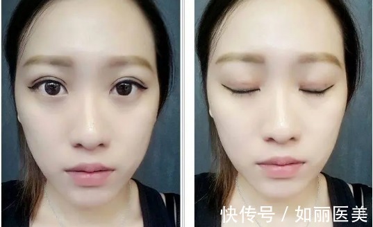 手术 想割双眼皮手术前,先看一下你的双眼合适割双眼皮手术吗?