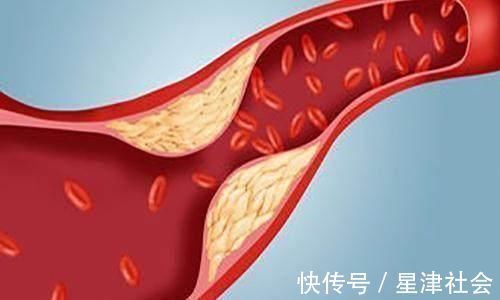 中老年人|身体出现这4个迹象,说明你的血脂超标了,别让心梗趁虚而入!