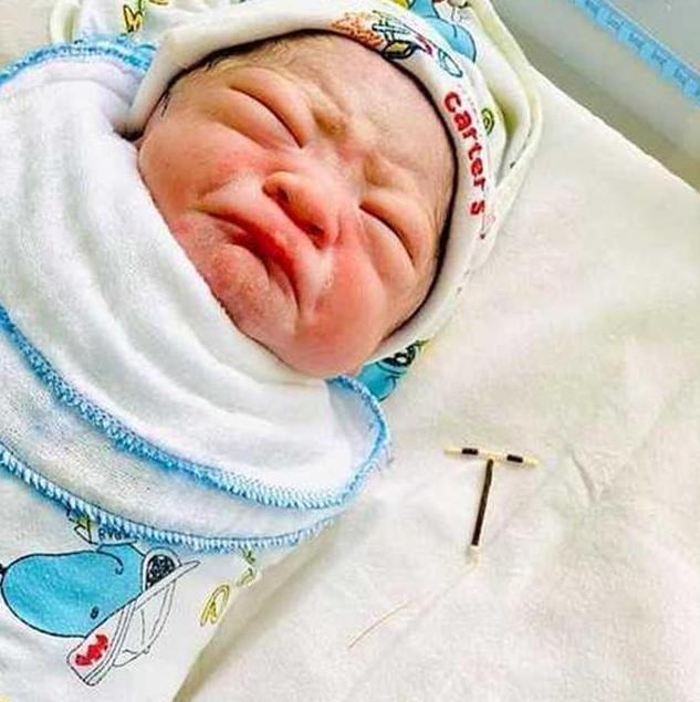 避孕套|34岁女子“上环”后仍怀孕,10个月后,宝宝握着“避孕环”出生