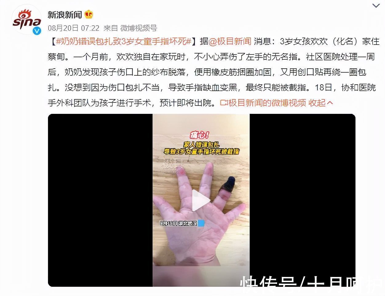 残疾|三岁女童被活活截断手指,终生残疾!只因用错创可贴,快自查