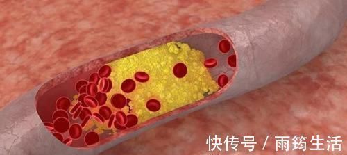 玉竹|甘油三酯高,吃3物,坚持1个月,血脂降到1.2,血管垃圾一扫光