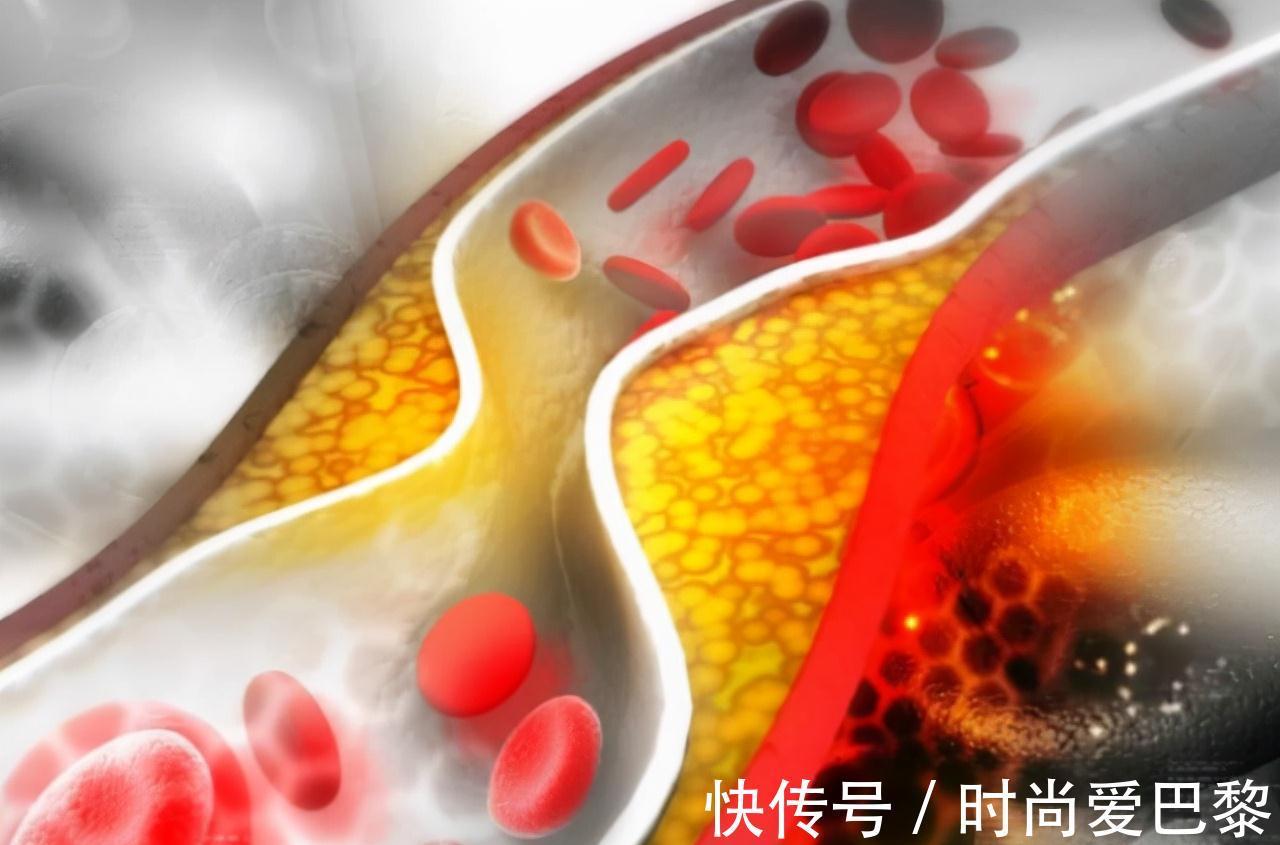 冠状动脉|多走路能降血脂?医生提醒:日常多吃这4物,或比走路效果好