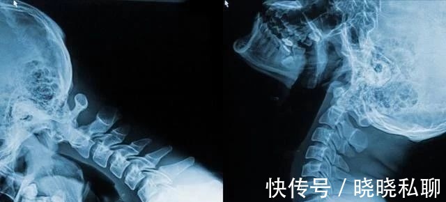 曲度|颈椎疼可以治好的,2个妙方,坚持一月,赶走头晕