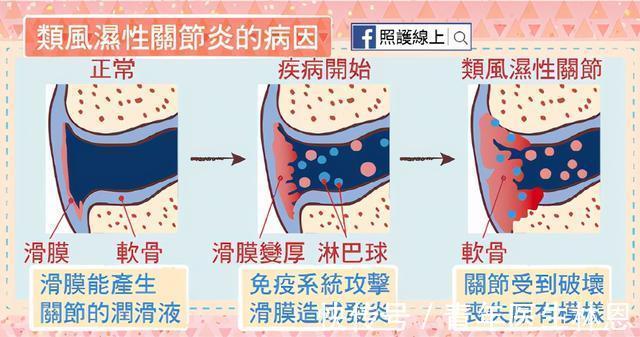 贫困|罹患“不死癌症”数十年,困扰张桂梅的这种疾病为何难以治愈?