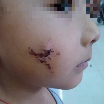 怀孕期间|因吃奶太用力,被妈妈用剪刀划花的男孩,如今怎么样了