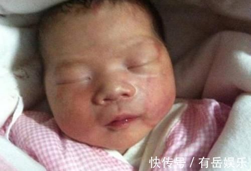 产钳|6个月宝宝产钳印明显,奶奶找医生“算账”,医生的话让她脸红