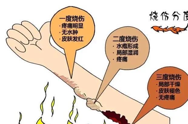 孩子身体被烫伤，先脱衣服还是先冲水？一步做错，孩子伤情会升级