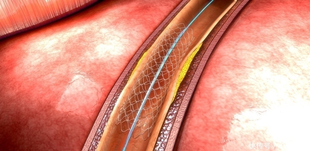 药物治疗|颈动脉的斑块,我要拿你怎么办?颈动脉斑块出现之后应该怎么做