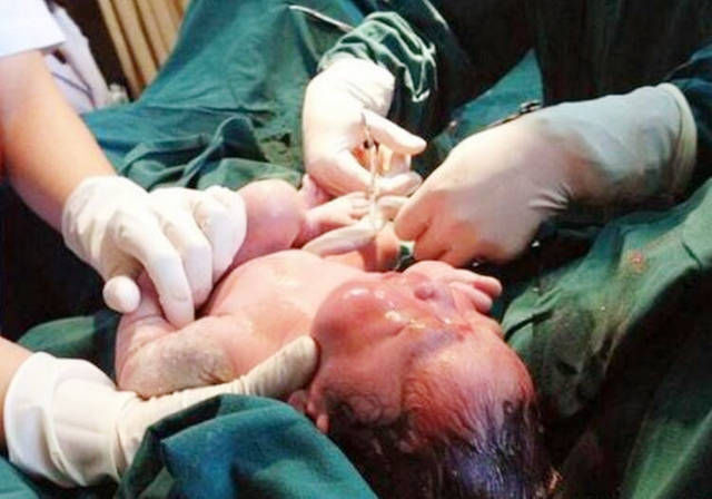 二胎|剖腹产有三种后遗症,生娃后难发觉,怀二胎时才显露,希望你没中