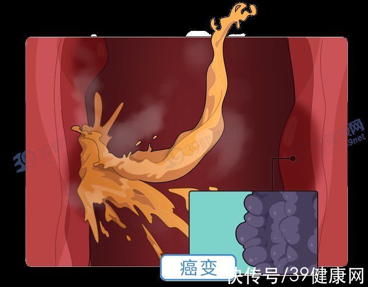 胃黏膜|“吃出来”的食道癌，为何全球一半患者在中国？3类人要重点关注