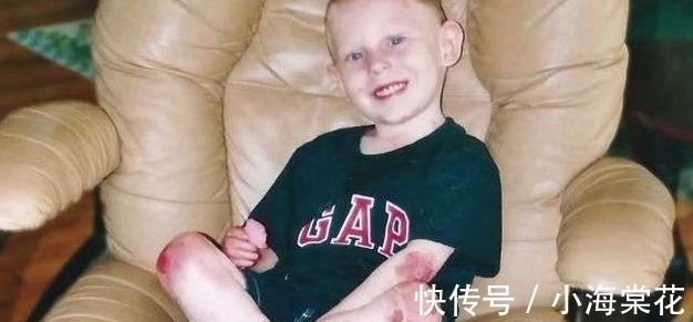 蝴蝶儿童|“蝴蝶儿童”!15岁男孩只要皮肤摩擦就长血泡,连洗澡都成磨难