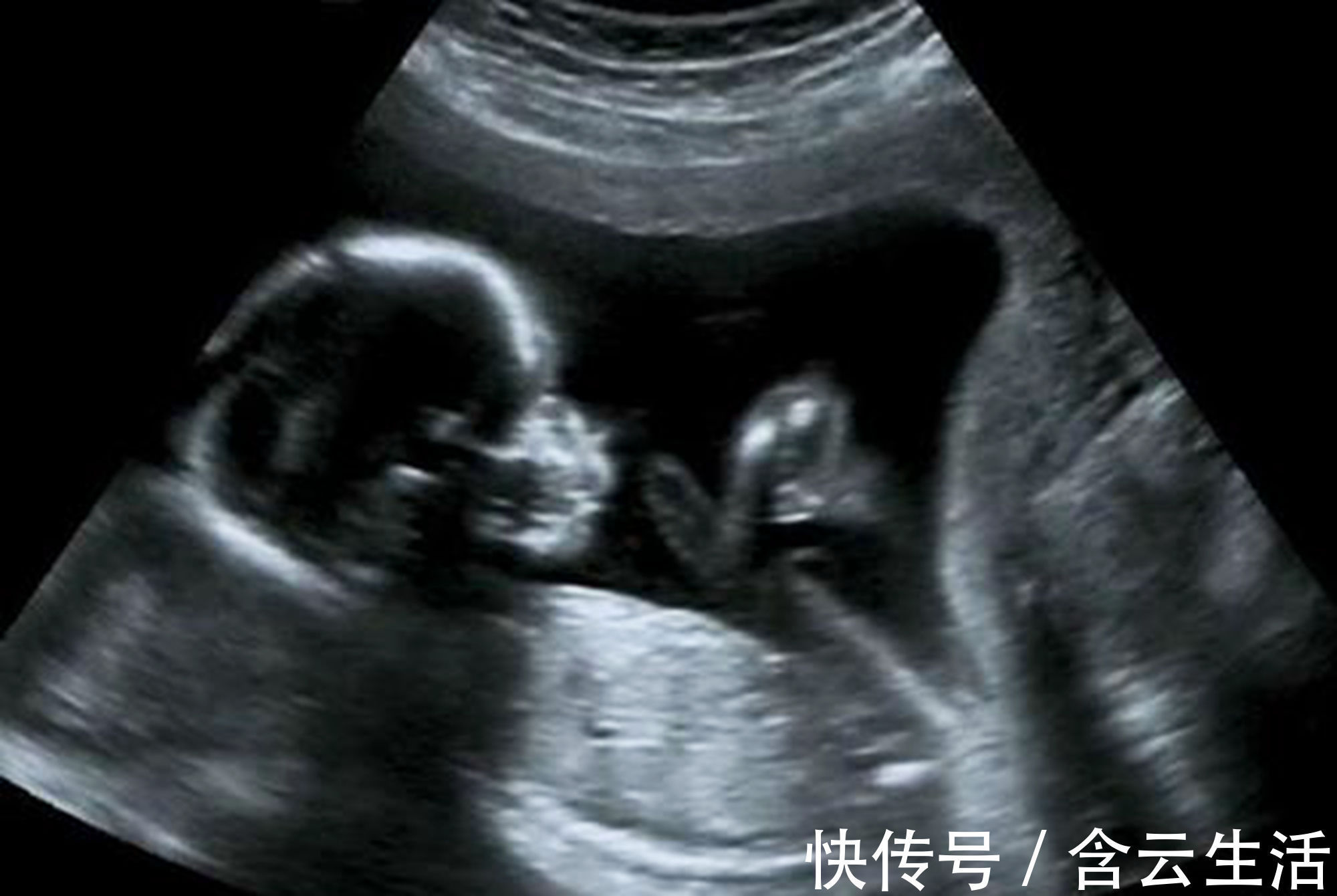 胎盘|孕早期B超单上的四个指标,暗含了胎儿的“小秘密”,你看得懂吗