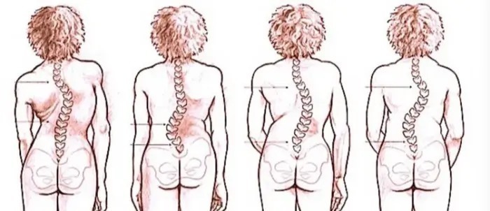 洗髓功|颈椎病的征兆，10种简单的锻炼颈椎病的方法