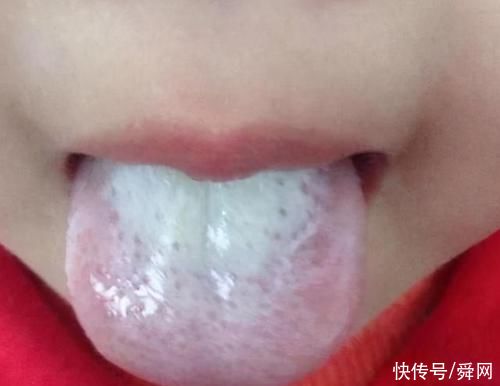 舌头|脾胃好不好，看舌头就知道!做好这2点脾胃问题大改善!