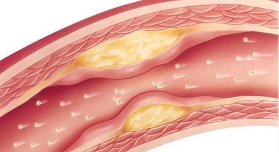 血压如何控制血管才不会爆裂?忠告:血压失控