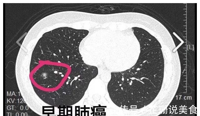 王教授|北大人民医院刘医生父亲查出了肺癌,希望放弃治疗,我没同意