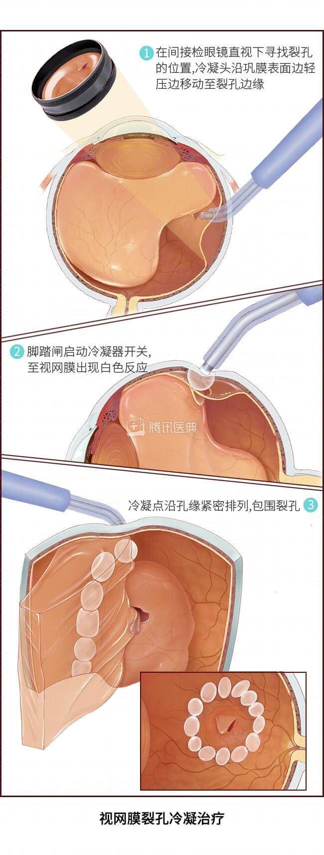  职场健康/28岁男子躺床上玩手机，差点瞎了一只眼