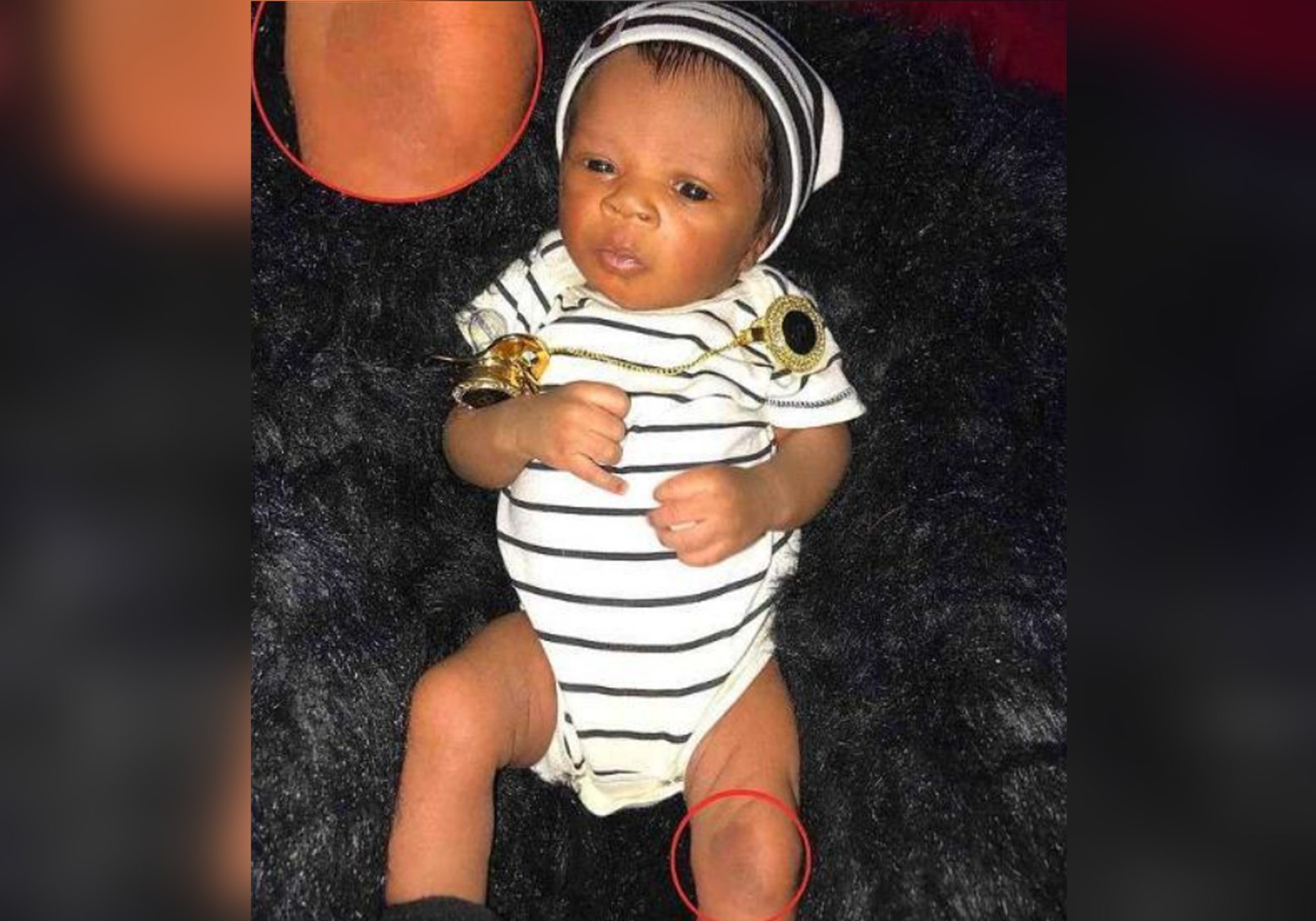 双胞胎|姐姐在腹中被弟弟“吸收”,化为胎记印在了弟弟腿上,爱的胎记