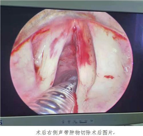 医生|大叔声音嘶哑，医生妙手祛顽疾