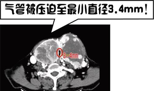 “俩头”在脖子上长了20年！直到喘不上气才看医