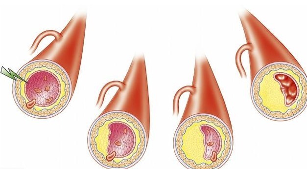 低血压|控制高血压,收缩压和舒张压哪个重要3种不同情况分别为你说清