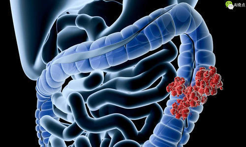 治疗|大肠癌一发现就是晚期，医生忠告，身体的两种小病最好及时治疗