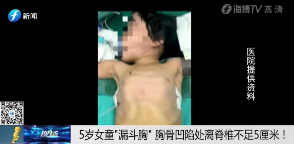  女童|5岁女童＂漏斗胸＂凹陷紧邻心脏，离脊椎不足5厘米！