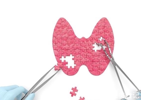 患上甲状腺结节|女性多发甲状腺结节怎么办?多吃3物,结节可能不药而愈