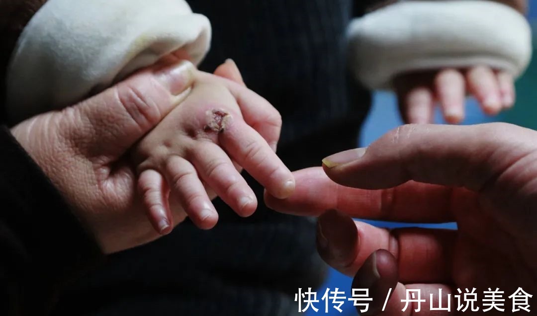 治疗费|漂亮女童身怀“特异功能”,没有痛觉,不会出汗,爸妈却因她流泪