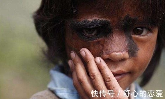 长相|9岁女孩因长相奇怪被称为“半脸怪物”,术后让人大开眼界