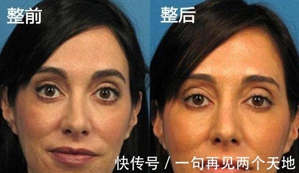 tri女子嫌弃自己拍照不上镜，花费10万元疯狂整容，整容后像20岁