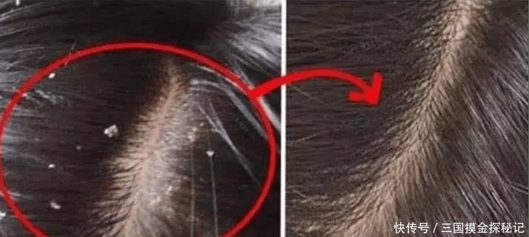 头皮|为什么头皮上会有这么多白色颗粒“状物”,你不知道的这3件事!