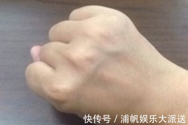 打针|身体健不健康,看手上青筋就知晓,可惜不少人还被“闷”在鼓子里