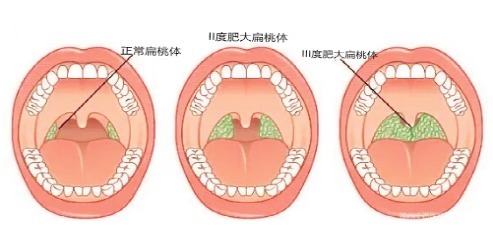 儿童腺样体、扁桃体肥大如何判断?